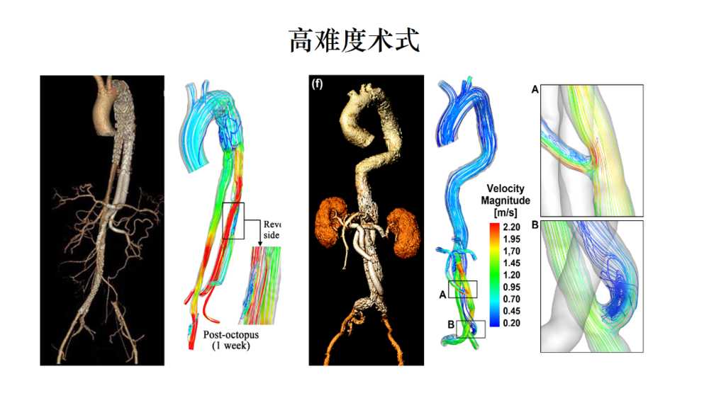 医学流体力学血流动力学仿真模拟有限元计算临床应用（动脉瘤等）培训班神外NS04